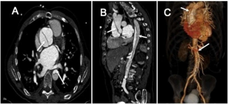 CT angiography of Stanford Type A aortic dissection showing intimal flap and 3D rendering