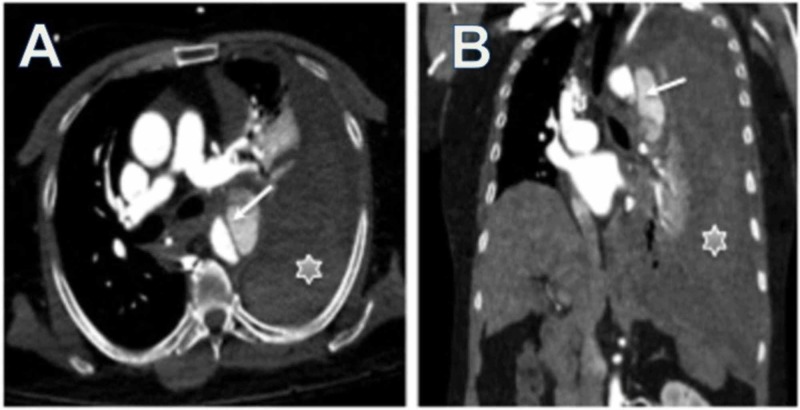 Stanford Type B thoracic aortic dissection with rupture and hemothorax on CT