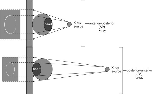 Diagram comparing AP versus PA chest X-ray projections showing cardiac magnification differences
