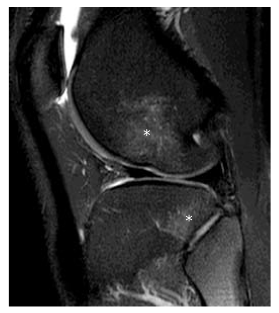 MRI showing bone bruises in lateral femoral condyle and posterolateral tibial plateau from ACL injury