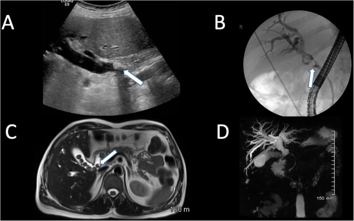 Multiple imaging modalities showing choledocholithiasis with filling defects in the common bile duct