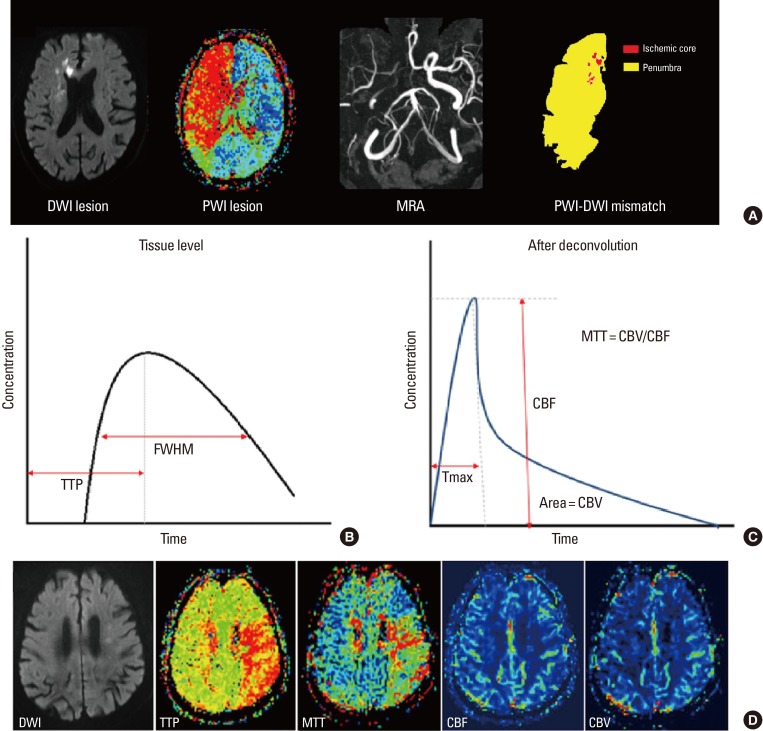 CT perfusion parameters including CBF, CBV, MTT, and Tmax maps in acute stroke