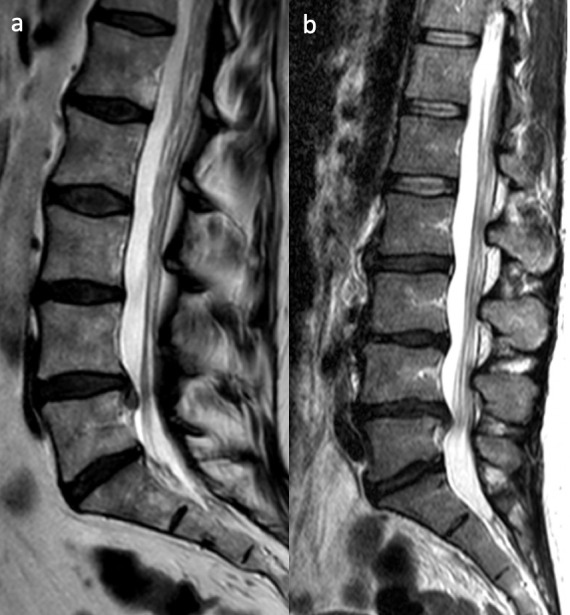 MRI showing lumbar disc herniation with comparison of normal and decreased disc height