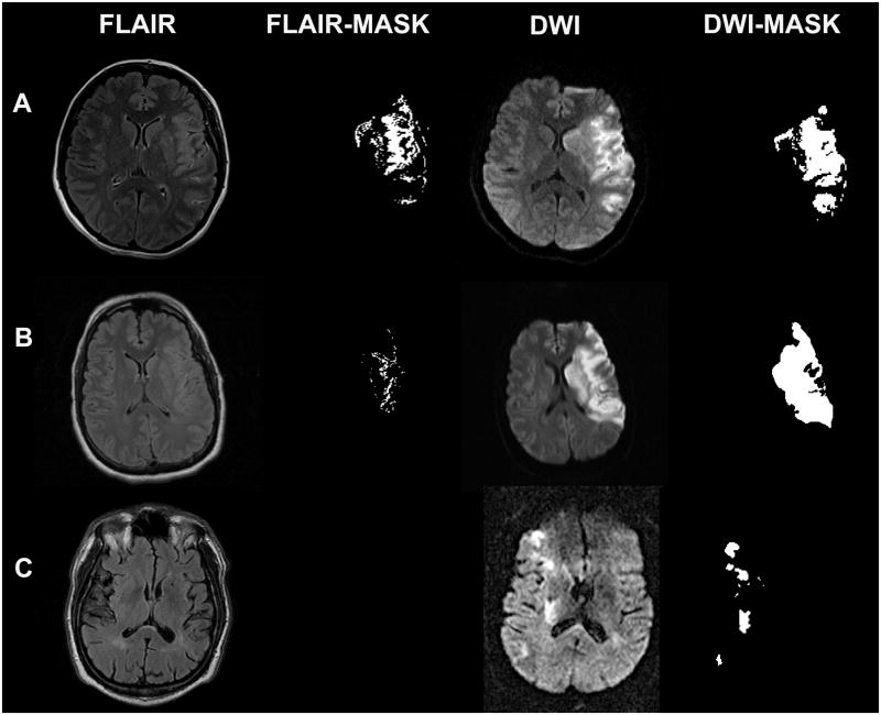 MRI showing DWI-FLAIR mismatch in acute ischemic stroke at different time points