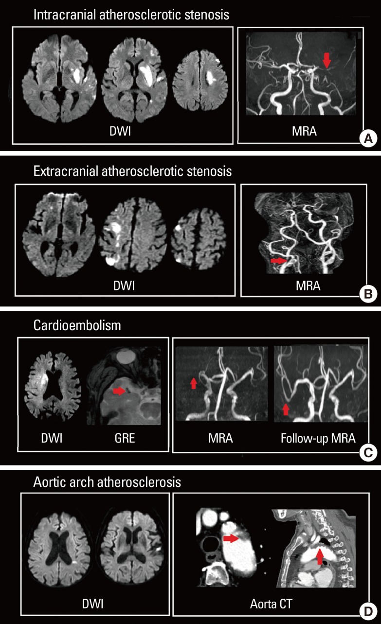 DWI lesion patterns showing different distribution by stroke subtype including atherosclerotic and cardioembolic