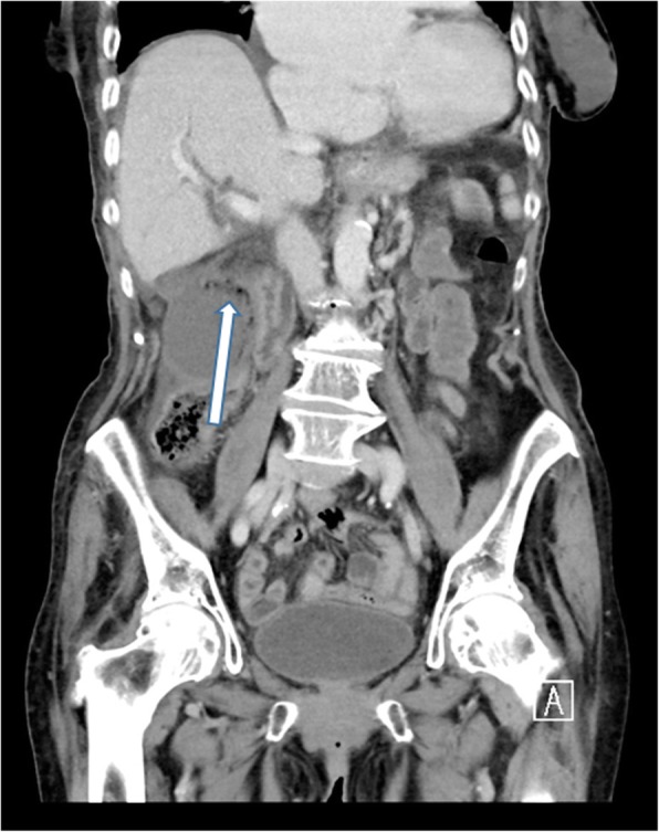 CT showing gas within the gallbladder wall in emphysematous cholecystitis