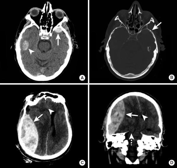 CT showing epidural hematoma biconvex lens-shaped and traumatic hemorrhagic contusion