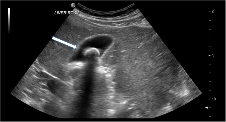Ultrasound showing hyperechoic gallstone with posterior acoustic shadowing
