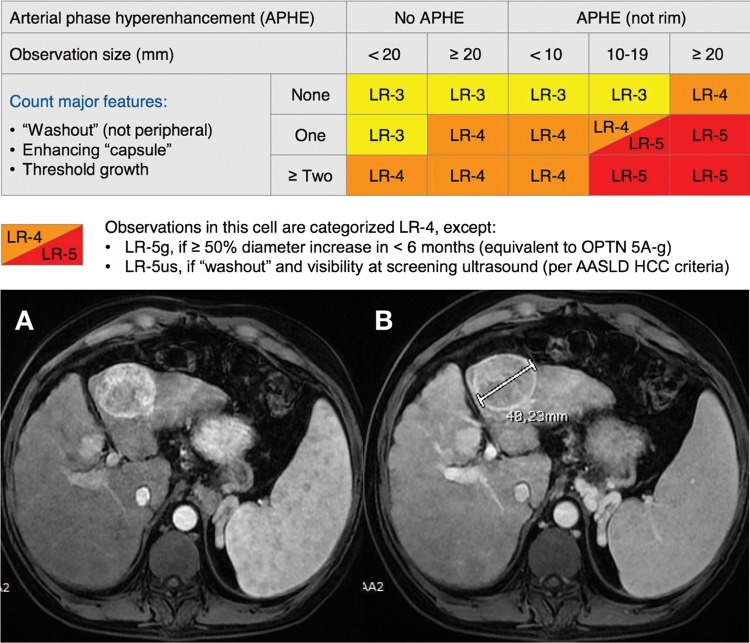 LI-RADS algorithm flowchart with MRI example showing HCC with arterial phase hyperenhancement and washout
