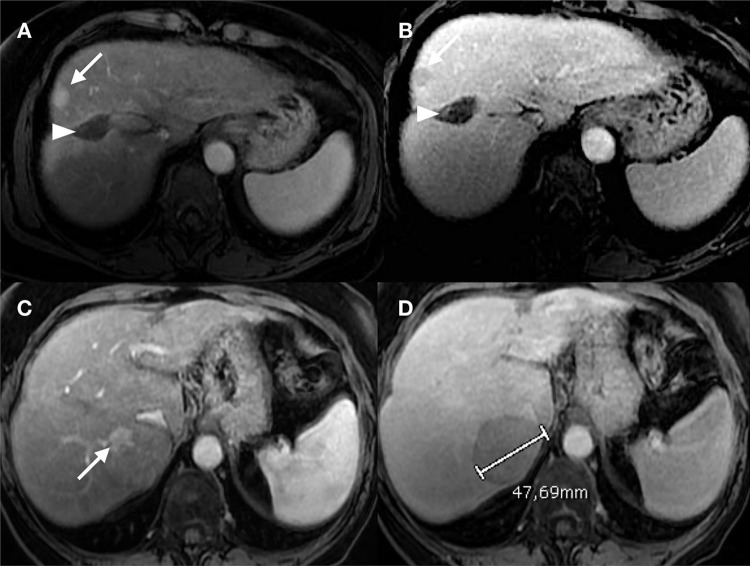 MRI demonstrating LR-5 hepatocellular carcinoma with arterial enhancement and washout