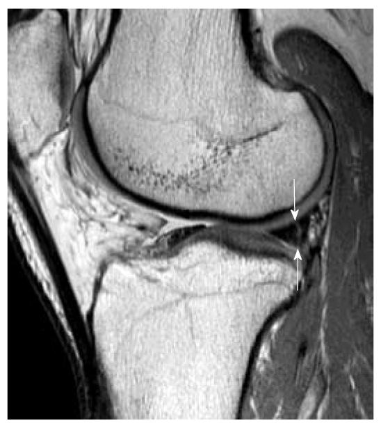 MRI showing peripheral vertical tear of posterior horn lateral meniscus associated with ACL injury