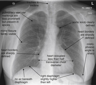 Normal PA chest X-ray with labeled anatomical structures