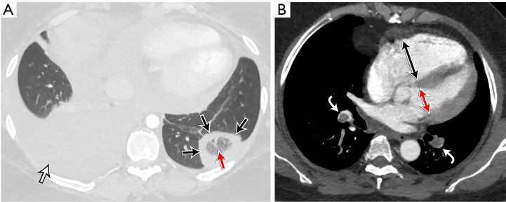 CT and imaging findings of pulmonary embolism sequelae including RV enlargement and pulmonary infarction