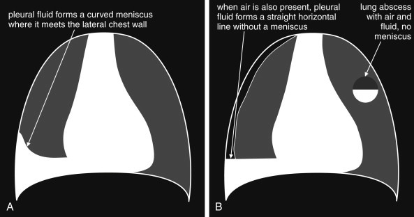 Chest X-ray showing pleural effusion with meniscus sign and schematic diagram