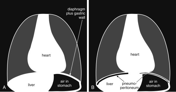 Upright chest X-ray showing free air under the diaphragm indicating pneumoperitoneum