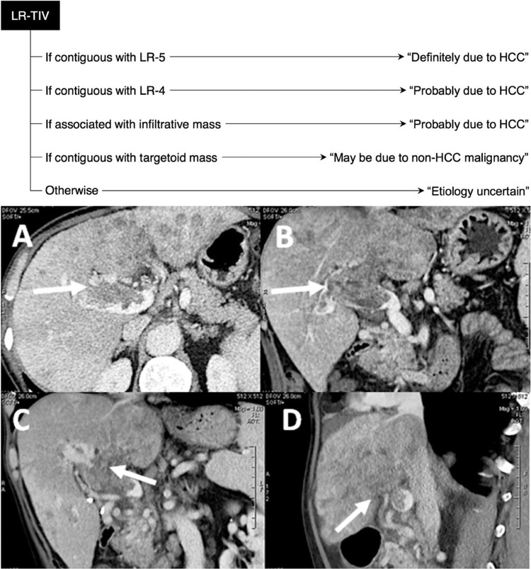 CT showing portal vein tumor invasion (LR-TIV) with enhancing soft tissue in the portal vein