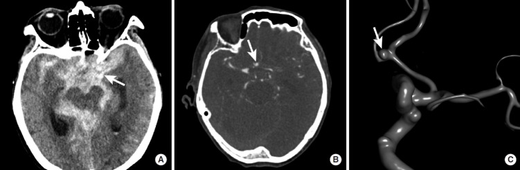 CT showing diffuse subarachnoid hemorrhage in basal cisterns from ruptured anterior communicating artery aneurysm