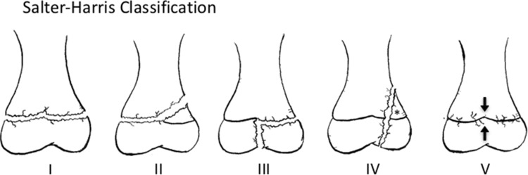 Schematic diagrams of all five Salter-Harris fracture types showing fracture lines relative to the growth plate