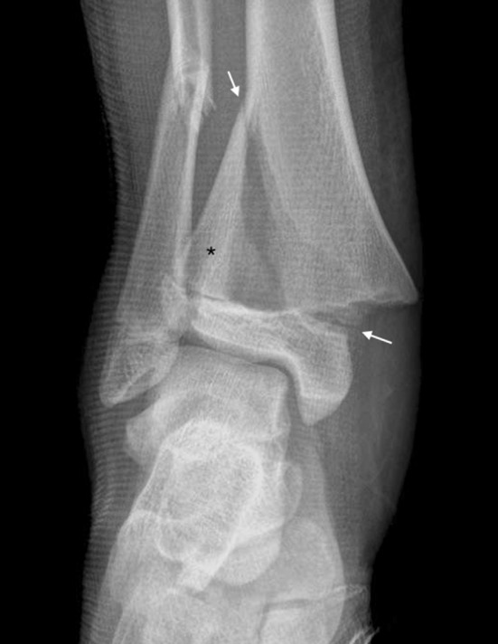 Radiograph showing Salter-Harris Type II fracture with Thurston-Holland metaphyseal fragment