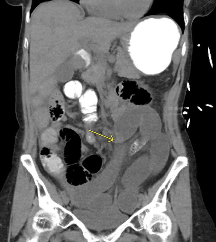CT showing small bowel obstruction with transition point from adhesive band