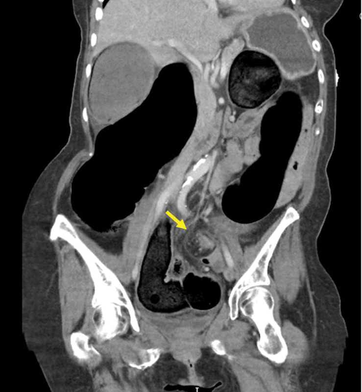 Coronal CT showing sigmoid volvulus with whirl sign at point of mesenteric torsion