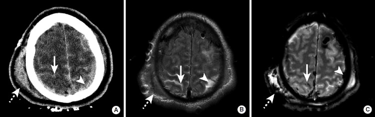 CT and MRI showing traumatic subarachnoid hemorrhage with subdural and subgaleal hematomas