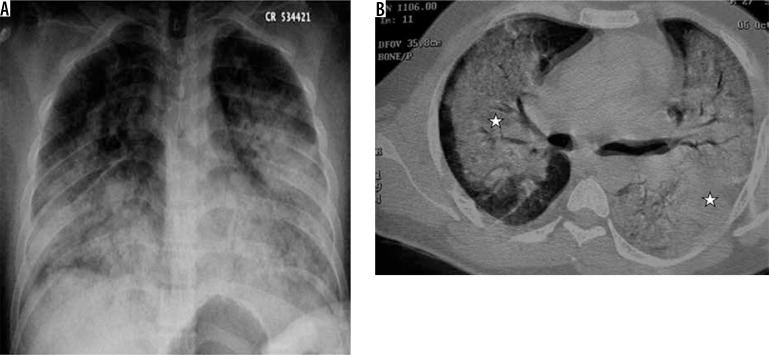 H1N1 viral pneumonia showing bilateral perihilar consolidation with air bronchograms