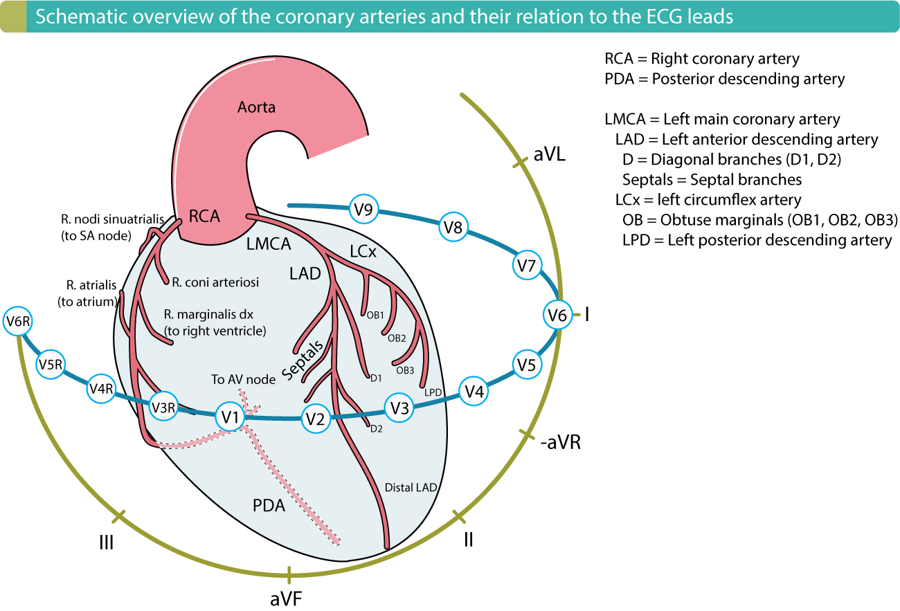 Diagram showing coronary artery territories and their corresponding ECG lead changes in STEMI: LAD (V1-V4), LCx (I, aVL, V5-V6), RCA (II, III, aVF)