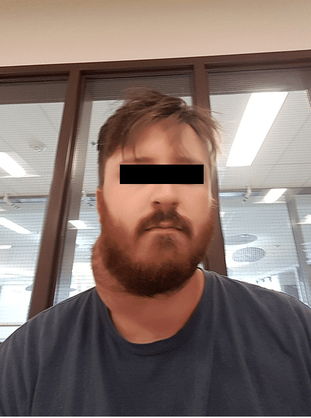 Branchial cleft cyst presenting as a lateral neck mass