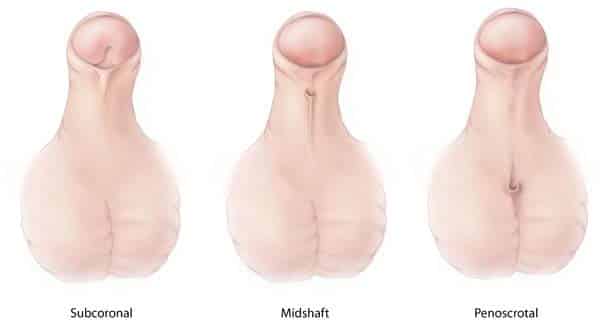 Types of hypospadias showing different locations of urethral opening