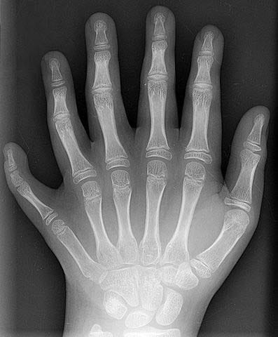 X-ray showing polydactyly with extra digits