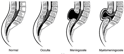 Types of spina bifida including occulta, meningocele, and myelomeningocele