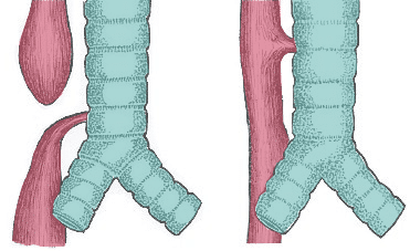 Types of tracheoesophageal fistula showing the most common variants