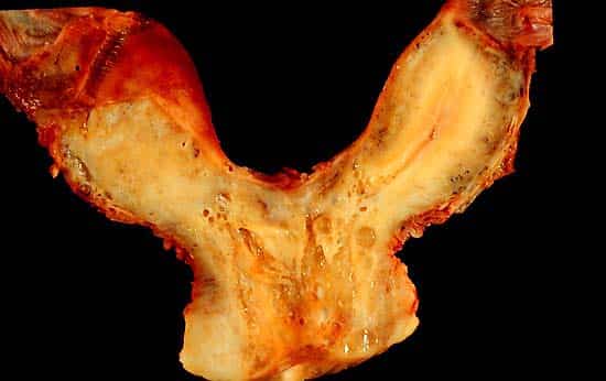 Bicornuate uterus as an example of Mullerian duct fusion anomaly