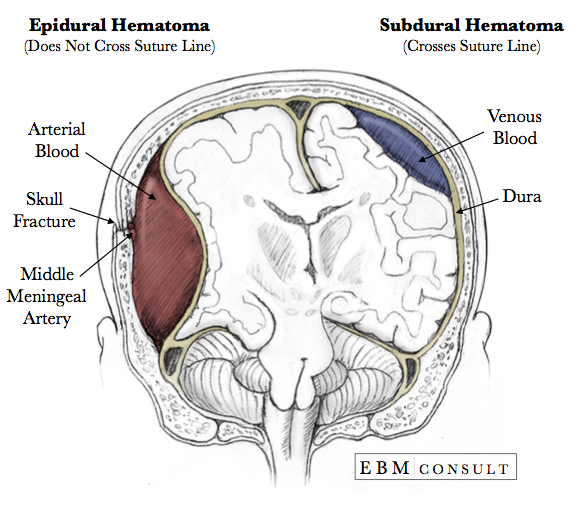 Comparison diagram showing epidural hematoma (lens-shaped, between skull and dura) and subdural hematoma (crescent-shaped, between dura and arachnoid)