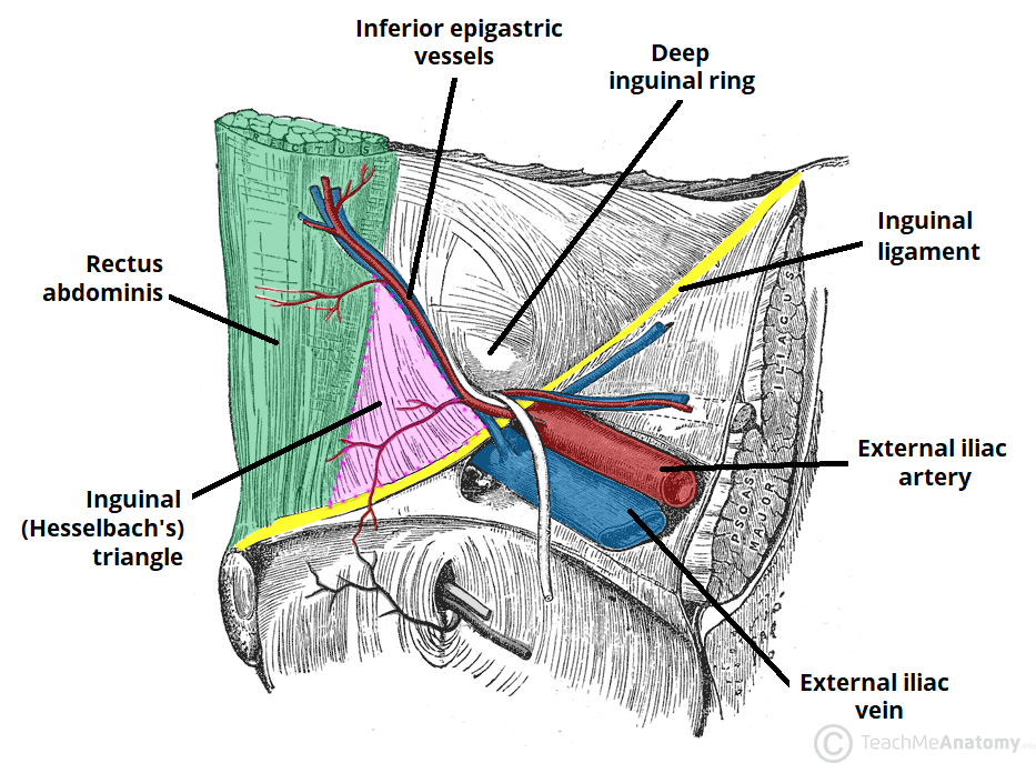 Diagram of Hesselbach triangle bounded by rectus abdominis, inguinal ligament, and inferior epigastric vessels