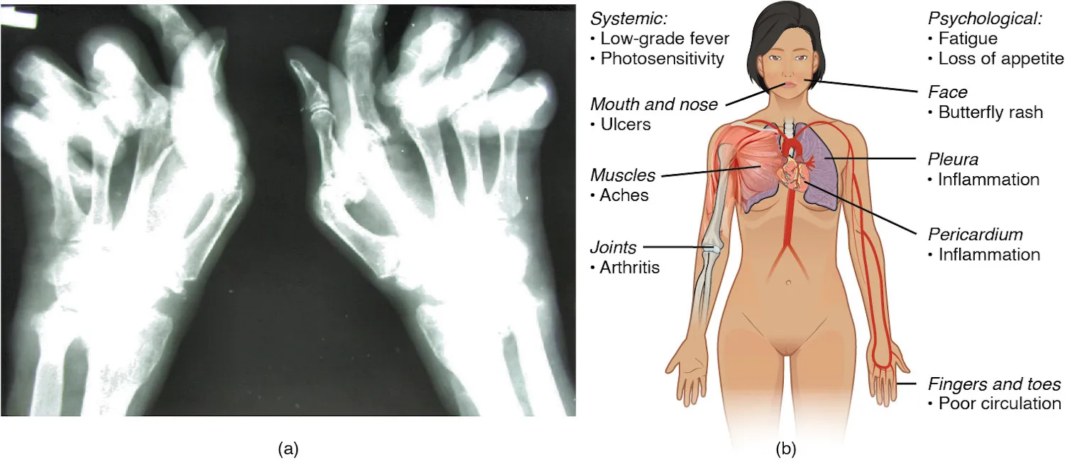 Overview of major autoimmune disorders including rheumatoid arthritis and systemic lupus erythematosus