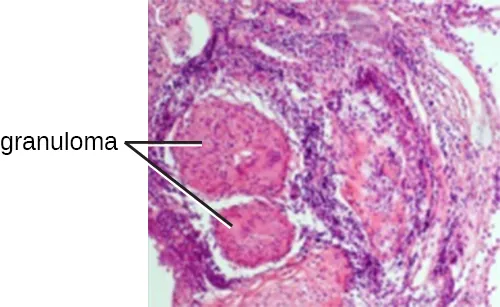 Granuloma structure showing epithelioid macrophages, giant cells, and lymphocyte collar