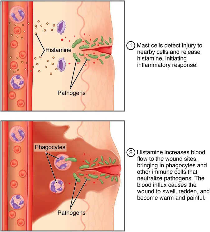 The inflammatory response showing vasodilation, increased permeability, and leukocyte migration