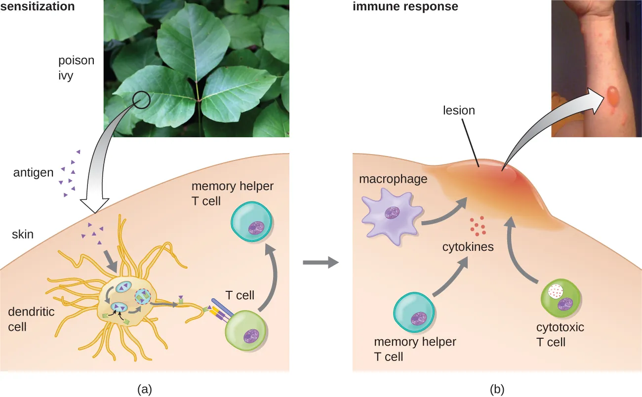 Type IV delayed-type hypersensitivity showing T-cell mediated contact dermatitis