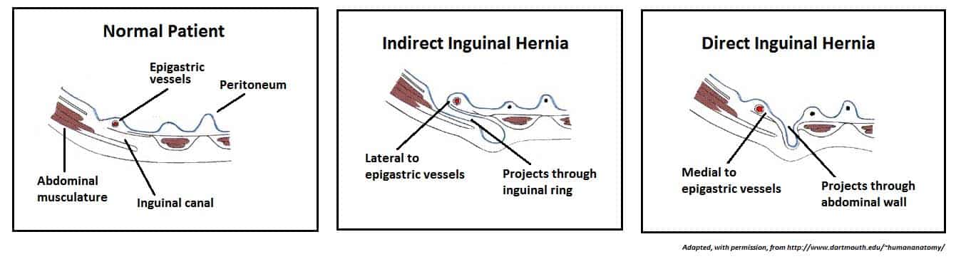 Comparison diagram of direct and indirect inguinal hernias showing their relationship to the inferior epigastric vessels