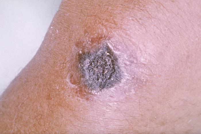 Cutaneous anthrax showing characteristic painless black eschar lesion