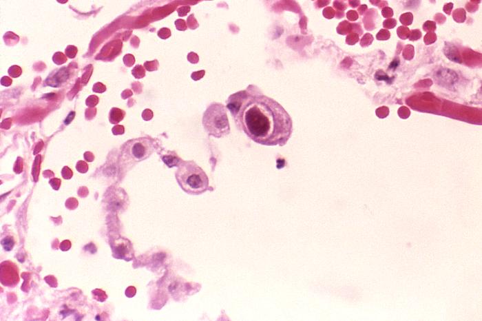 Histological section showing CMV owl-eye intranuclear inclusion bodies