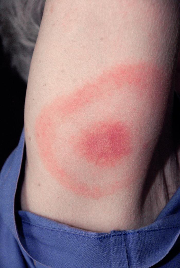 Erythema migrans rash of early Lyme disease showing characteristic bull's-eye pattern