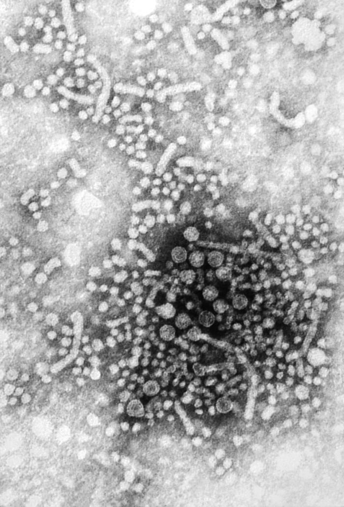 Tzanck smear showing multinucleated giant cells from herpes simplex virus infection