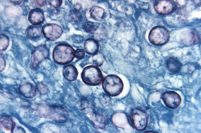 Histoplasma capsulatum yeast forms within macrophages on silver stain