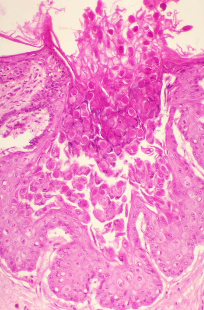 Measles maculopapular rash spreading from face to trunk and extremities