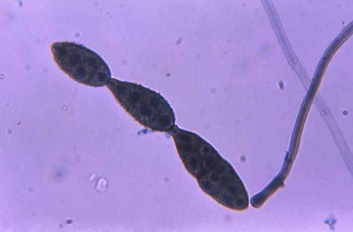 Mucormycosis histology showing broad non-septate hyphae branching at right angles