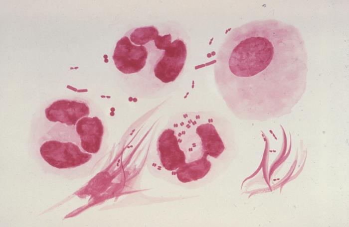 Gram stain showing Gram-negative intracellular diplococci characteristic of Neisseria
