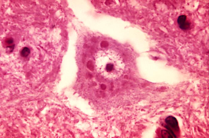 Histological section showing Negri bodies in neurons characteristic of rabies virus infection
